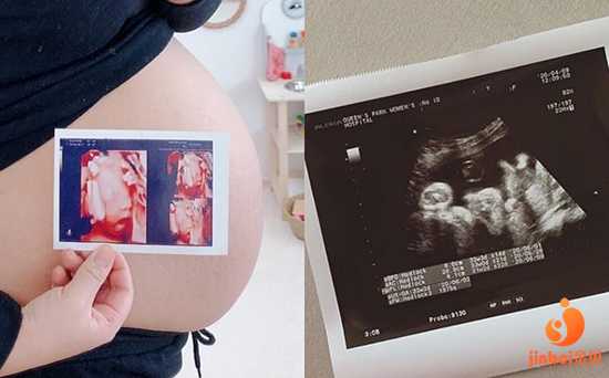 【上海仁济医院供卵吗】月子快结束了，分享孕期和手术感言（下）
